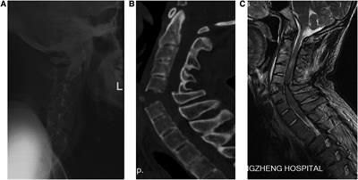 Comparative study of halo-vest reduction and skull traction reduction in the treatment of cervical fracture dislocation in patients with ankylosing spondylitis